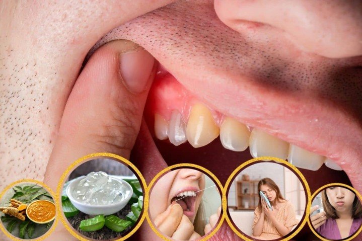 Natural Ways to Disinfect Gums After Flossing