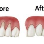 Fix Receding Gums Naturally