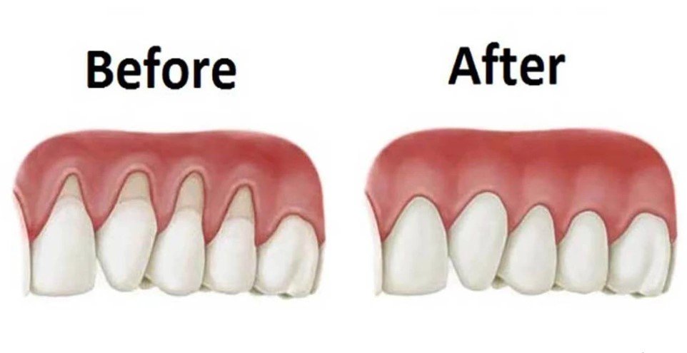 Fix Receding Gums Naturally
