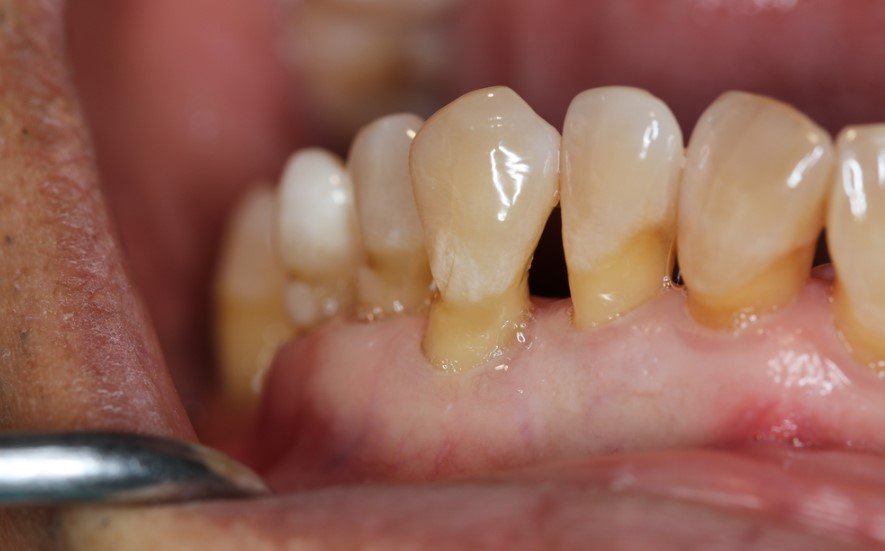 Understanding Gum Recession