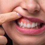 Gum recede arround crown