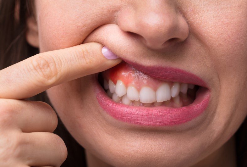 Gum recede arround crown