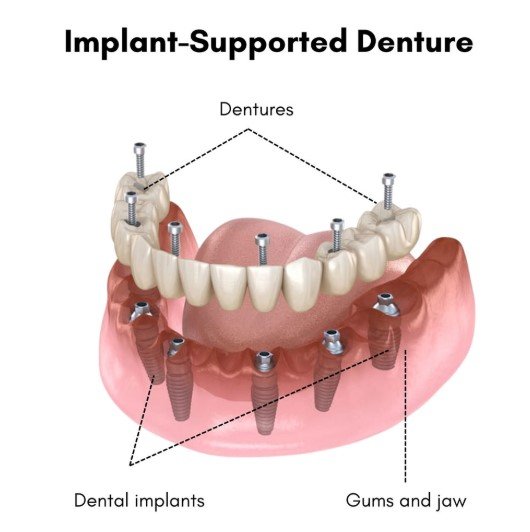Implant-Supported Dentures