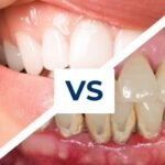 Is Gum Disease Permanent