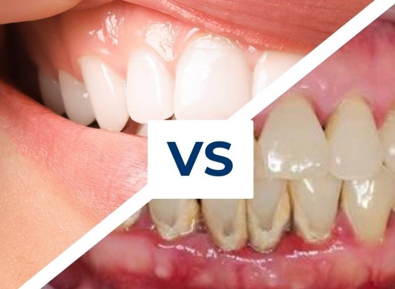 Is Gum Disease Permanent