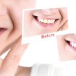 Natural Remedies for Teeth Whitening That Work Safely at Home