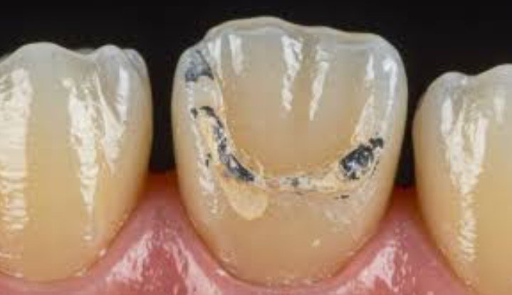 Old or damaged crowns