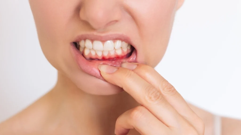 Pyorrhea Gum Disease