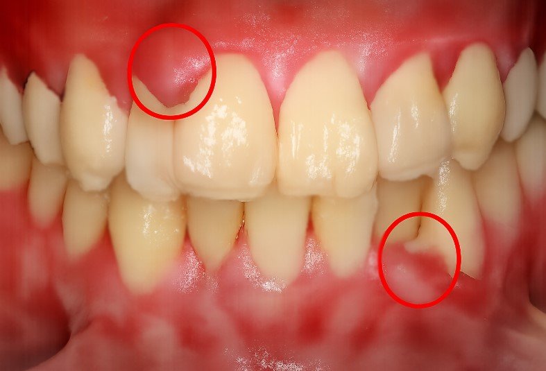 Signs of Disinfect Gums