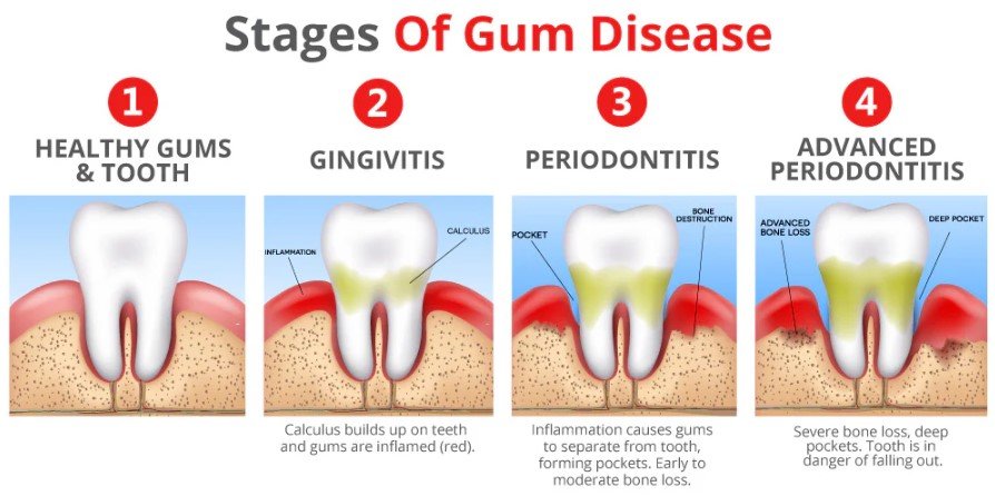 Stages of Gum Disease
