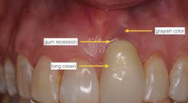 Symptoms of Receding Gums Around Crowns