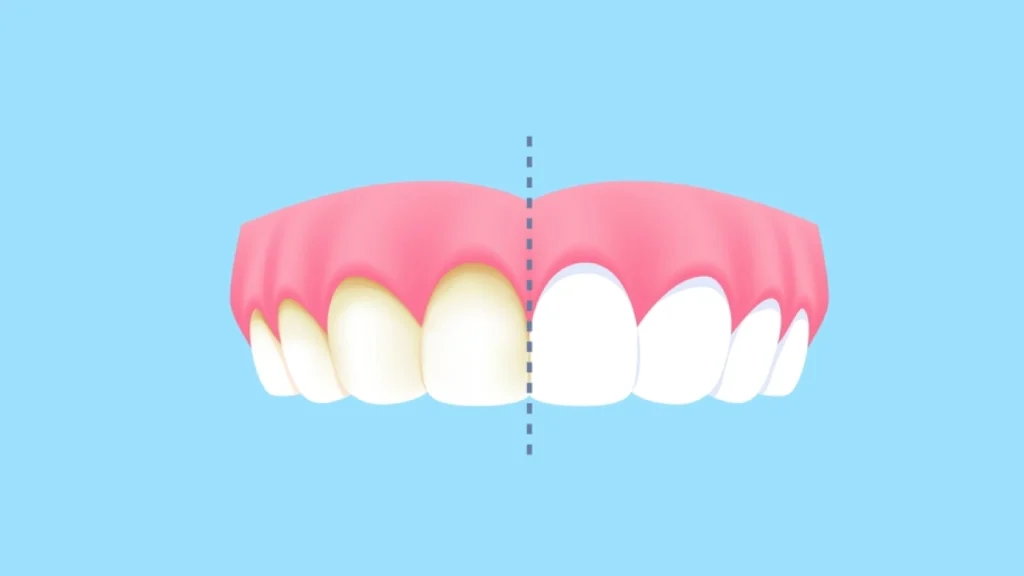 Teeth to Look Yellow or Stained