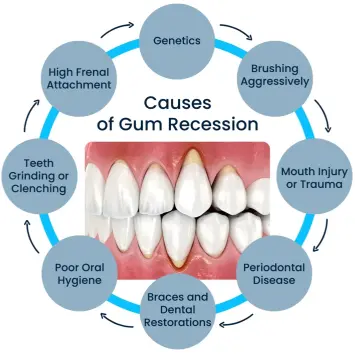 Top Causes of Gum Recession Around Crowns