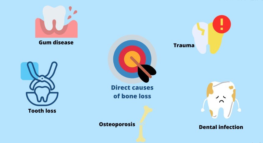 Causes of Jaw Bone Loss Around Teeth
