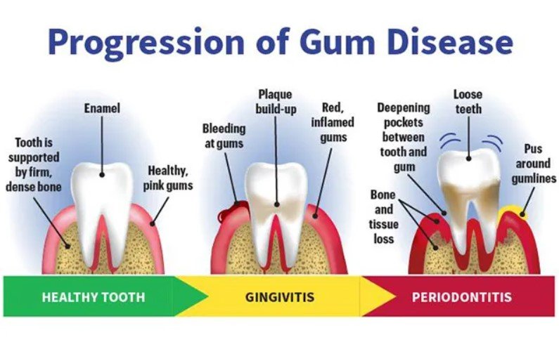 Common Gum Problems Caused by Dipping
