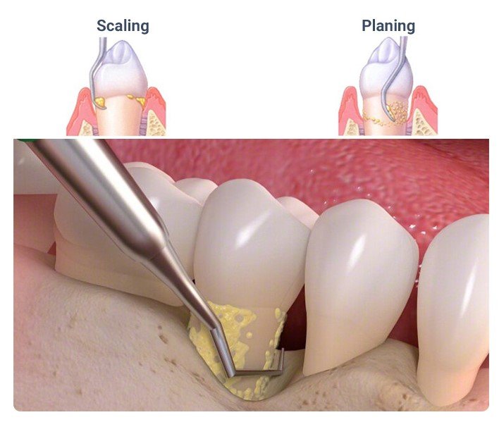 Deep Cleaning for early gum disease