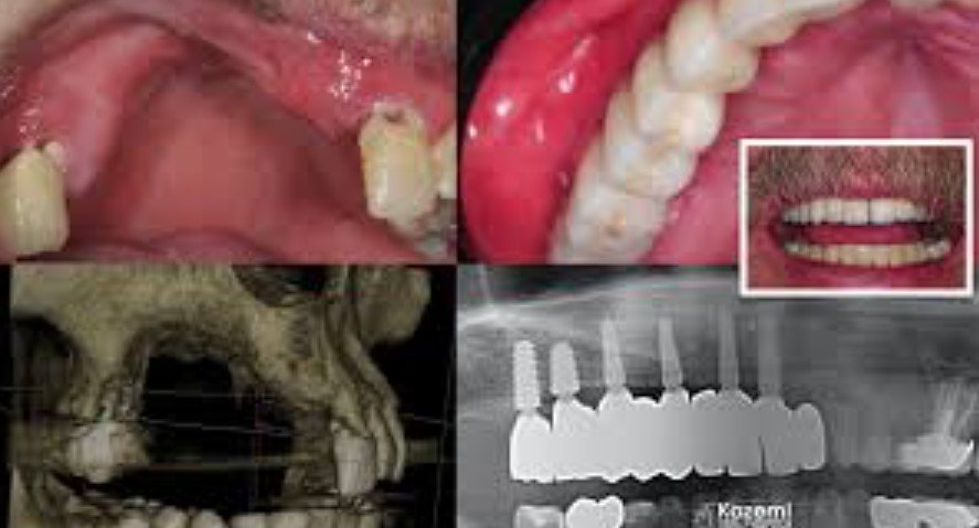 Dentists Diagnose Bone Loss