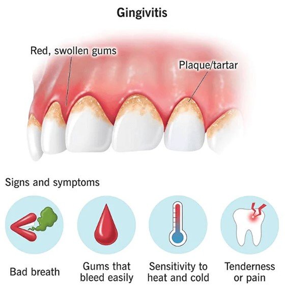 Gingivitis Cause Bad Breath