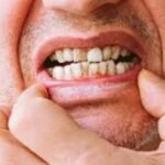 Gum Disease From Dipping