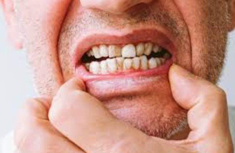 Gum Disease From Dipping