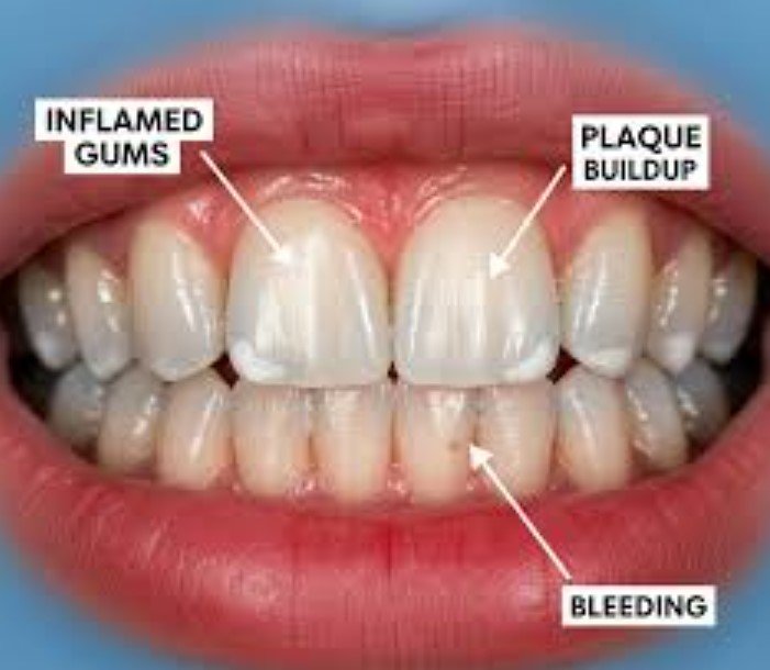 What is Gum Disease