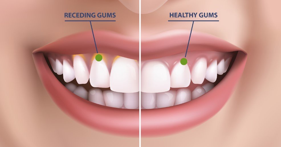 What to Use for Receding Gums