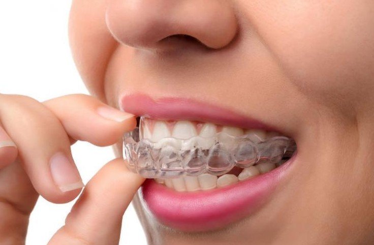 Address Teeth Grinding (Bruxism)