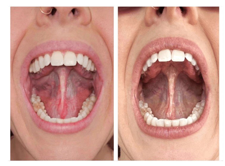 Before and after Surgery Oral Tie