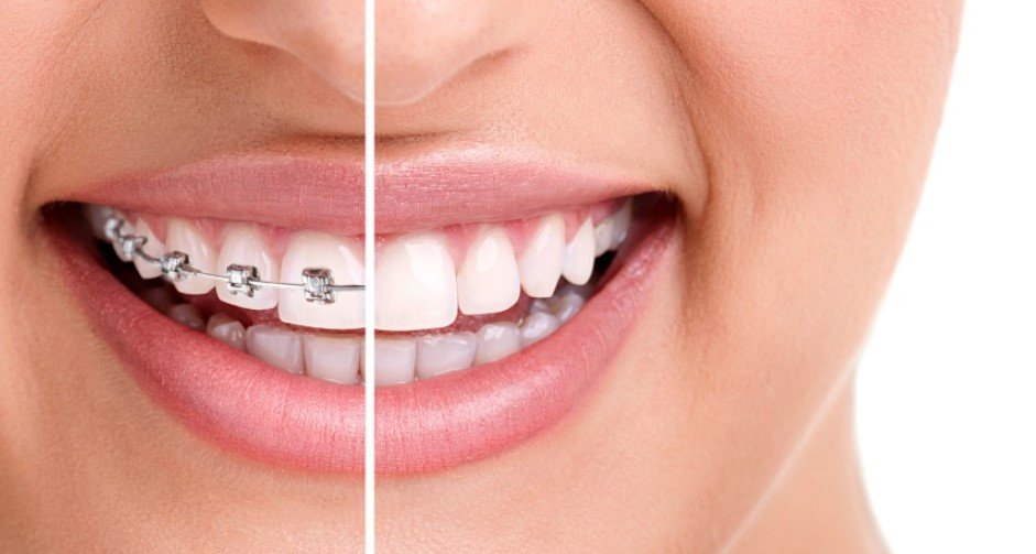 Fluoride Treatment and Braces