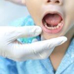 Oral Tie Release
