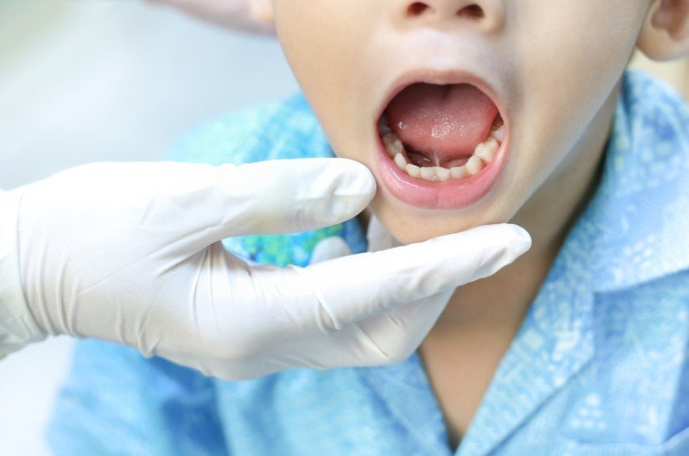 Oral Tie Release