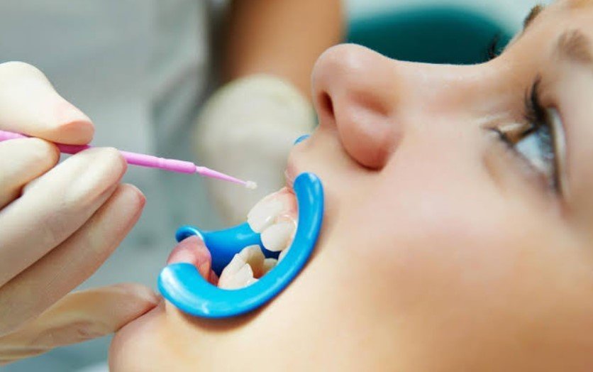 Patchogue fluoride treatment for dental care