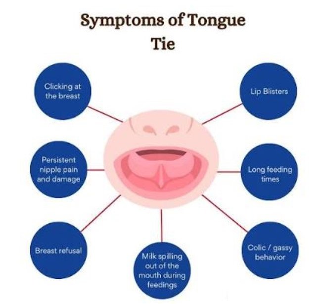 Signs of Oral Ties