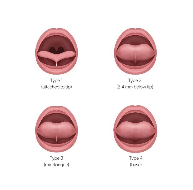 Types of Oral Ties